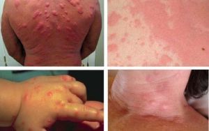 Симптомы аллергии на укусы клопов