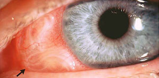 Причины попадания глистов в глаза