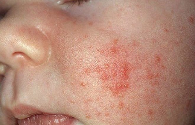 Аллергия на гентамицин