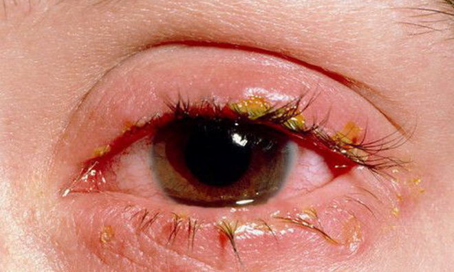 Инфекционное забалевания глаз