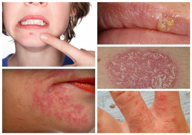 Какие аллергические реакции считаются симптомами наличия глистов
