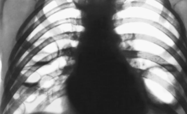 Рентгенограмма органов грудной клетки в прямой проекции при туляремии
